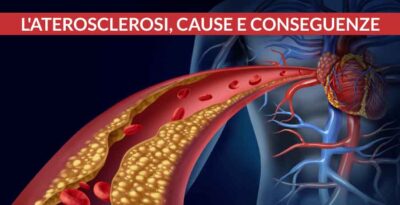 L’aterosclerosi, cause e conseguenze