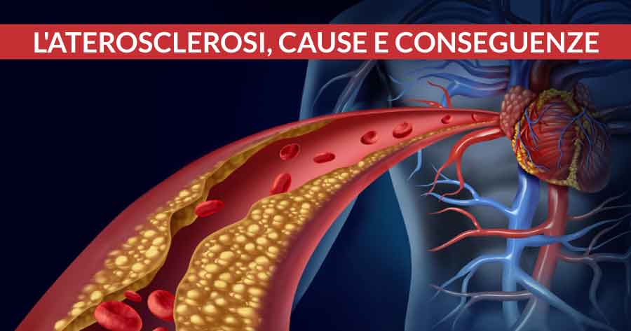 aterosclerosi-cause-e-conseguenze-cardiocenter-napoli