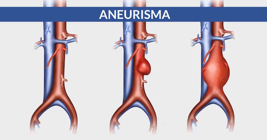 cose-un-aneurisma-cardiocenter-napoli