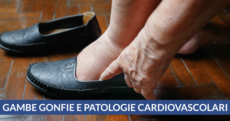 gambe-gonfie-e-patologie-cardiovascolari-cardiocenter-napoli