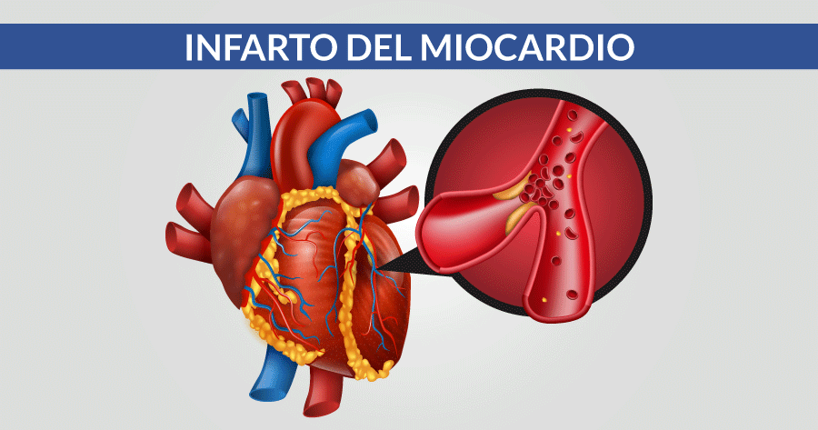 infarto miocardio problematiche cardiologiche e cardiovascolari