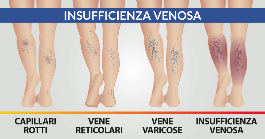 insufficienza-venosa-napoli-cardiocenter