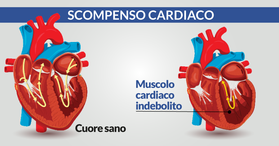 scompenso-cardiaco-cause-sintomi-e-terapia-cardiocenter