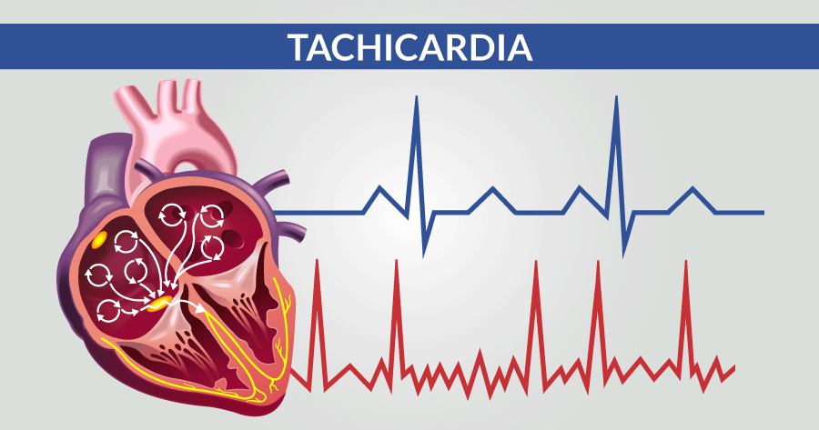 tachicardia problematiche cardiologiche e cardiovascolari