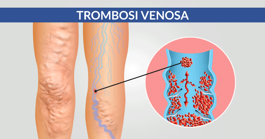 trombosi venosa problematiche cardiologiche e cardiovascolari