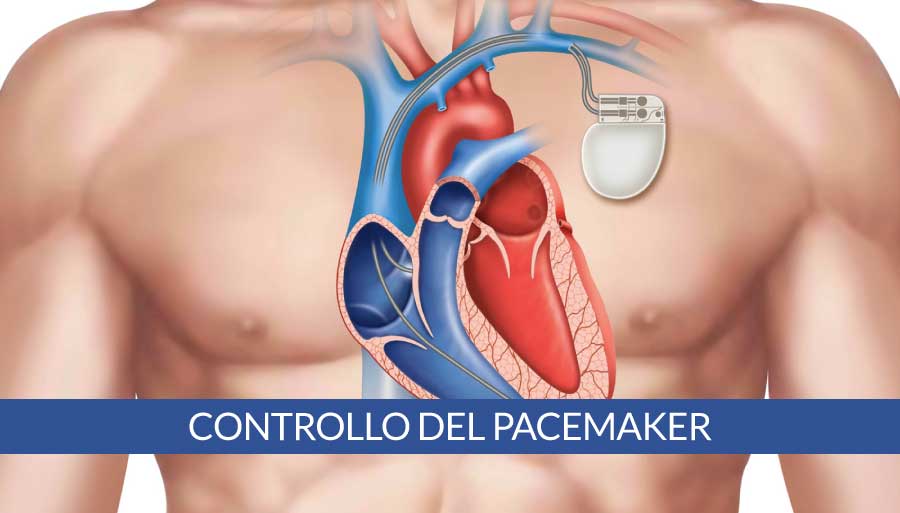 controllo-del-pacemaker-a-napoli-cardiocenter