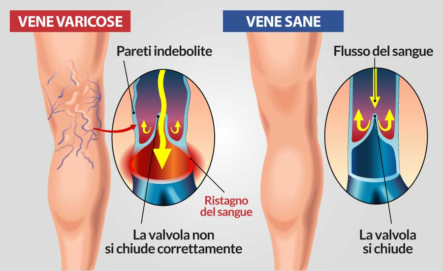 insufficienza-venosa-foto-illustrativa