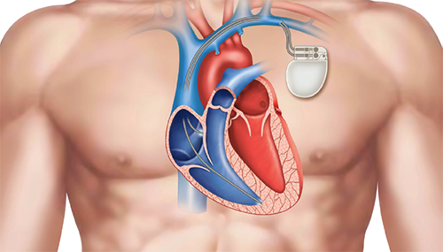 controllo-del-pacemaker-cardiocenter-a-napoli