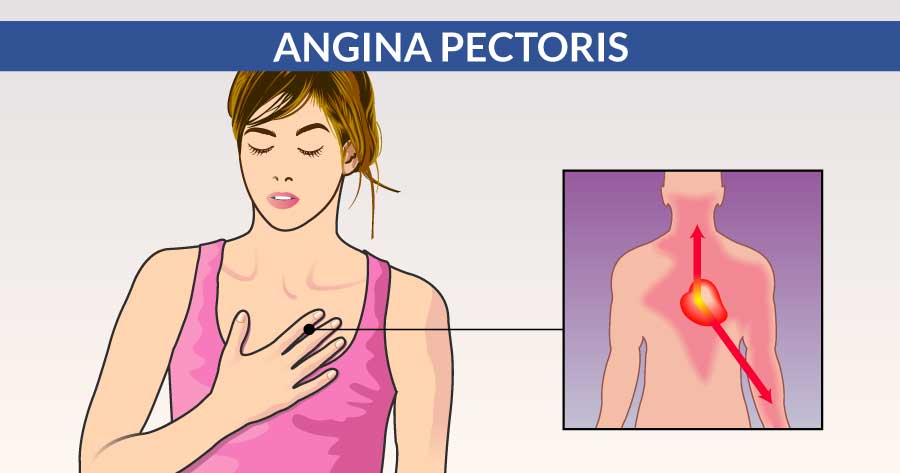 angina-pectoris-diagnosi-e-trattamento-napoli-cardiocenter