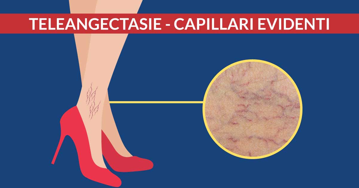 capillari-delle-gambe-cause-e-trattamento