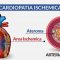 Cardiopatia ischemica
