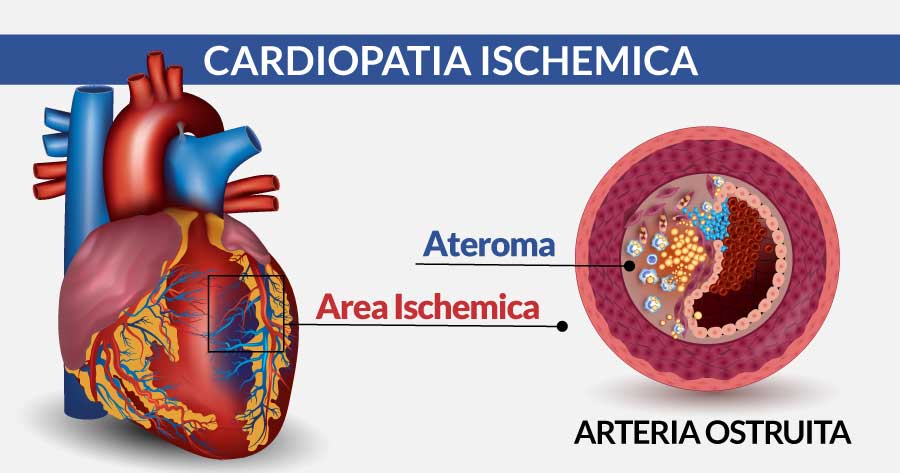 cardiopatia-ischemica-napoli-cardiocenter