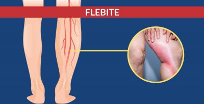 Flebite, diagnosi e trattamento