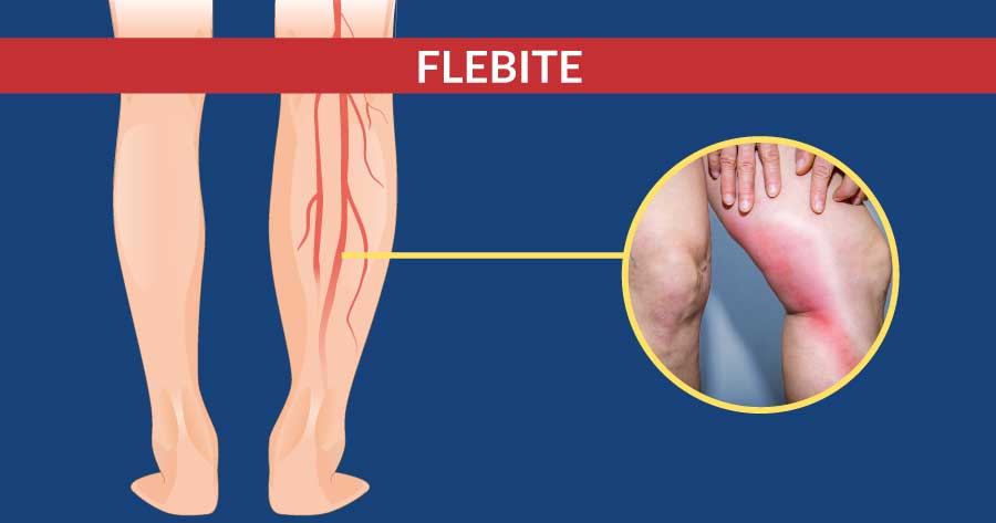 flebite-diagnosi-e-trattamento-cardiocenter-napoli
