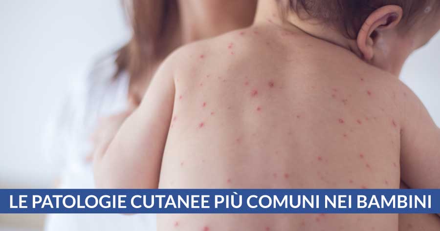 le-patologie-cutanee-piu-comuni-nei-bambini-cardiocenter