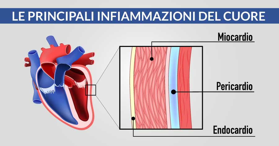 quali-sono-le-principali-infiammazione-del-cuore-cardiocenter-napoli