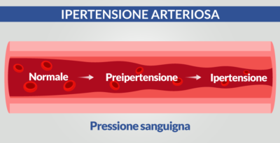Ipertensione arteriosa, cause e diagnosi