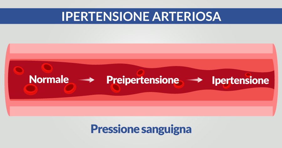 ipertensione-arteriosa-cardiocenter-napoli