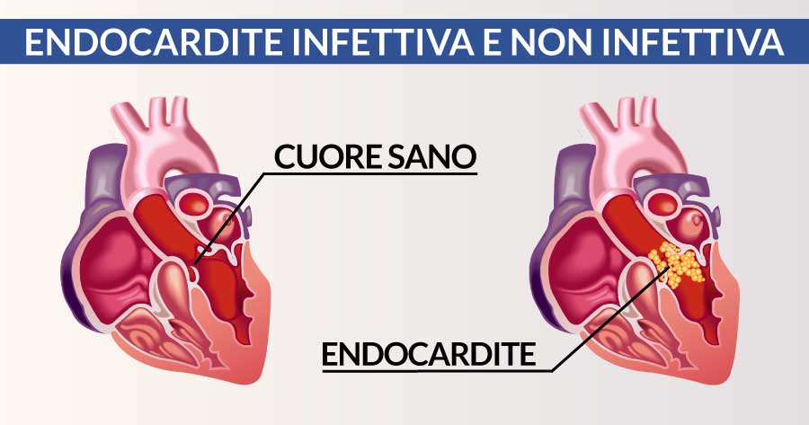 endocardite-infettiva-e-non-infettiva-cardiocenter-napoli