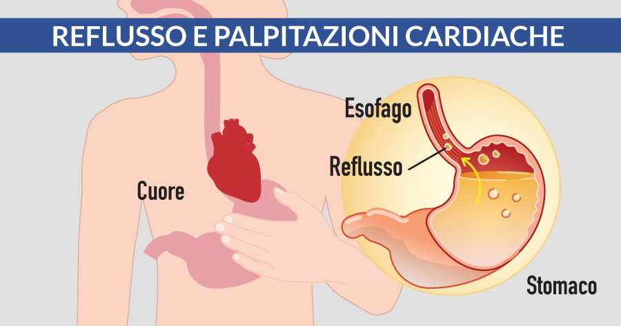 reflusso-e-palpitazioni-cardiache-cardiocenter-napoli