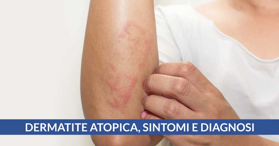 dermatite atopica cardiocenter napoli