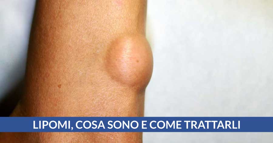 lipoma diagnosi e trattamento