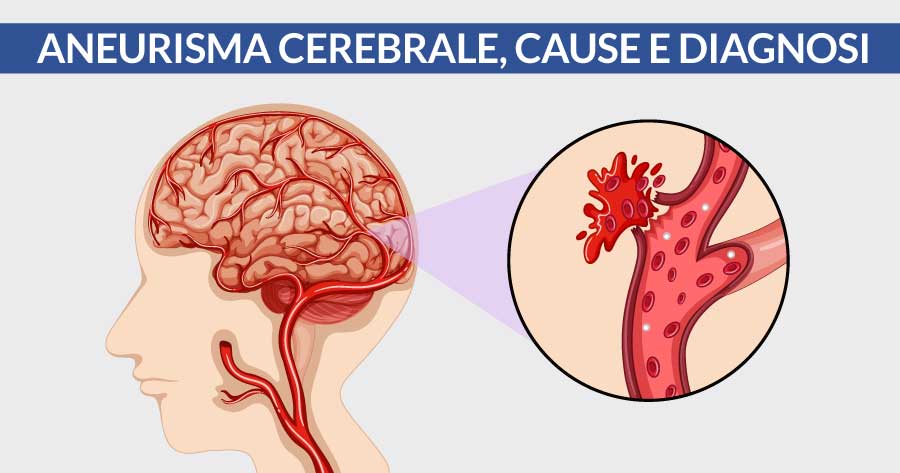 aneurisma-cerebrale-cardiocenter-napoli