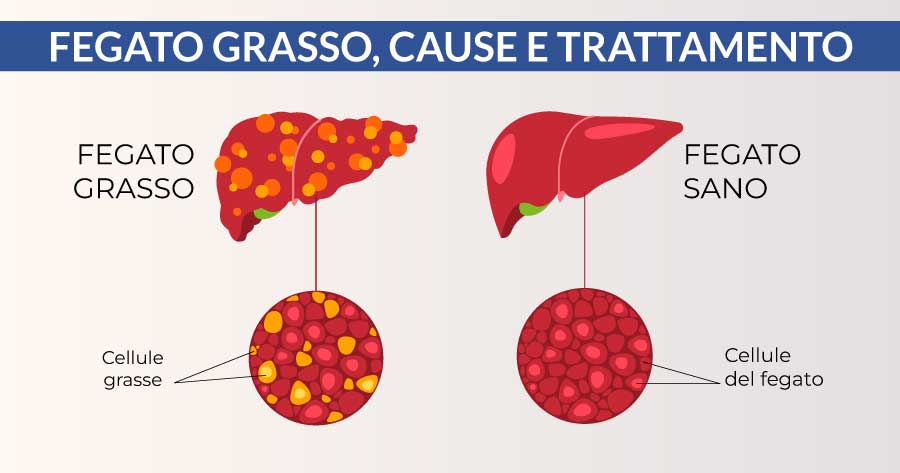 fegato-grasso-cardiocenter-napoli