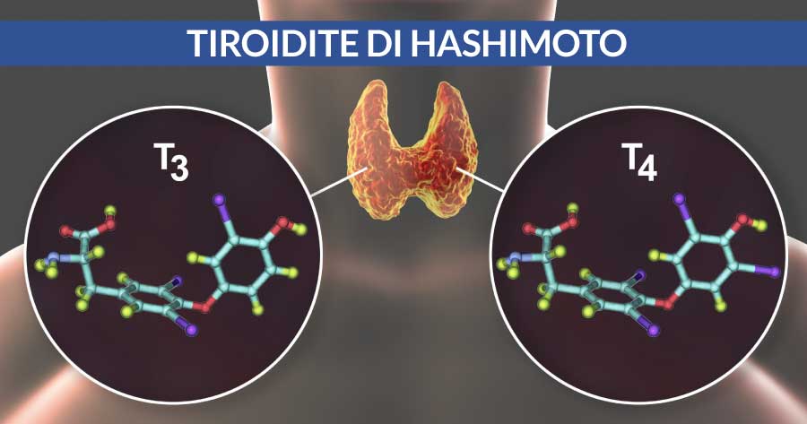 tiroidite di hashimoto cardiocenter napoli