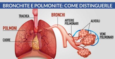 Bronchite e Polmonite: come distinguerle