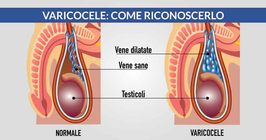 varicocele come riconoscerlo cardiocenter