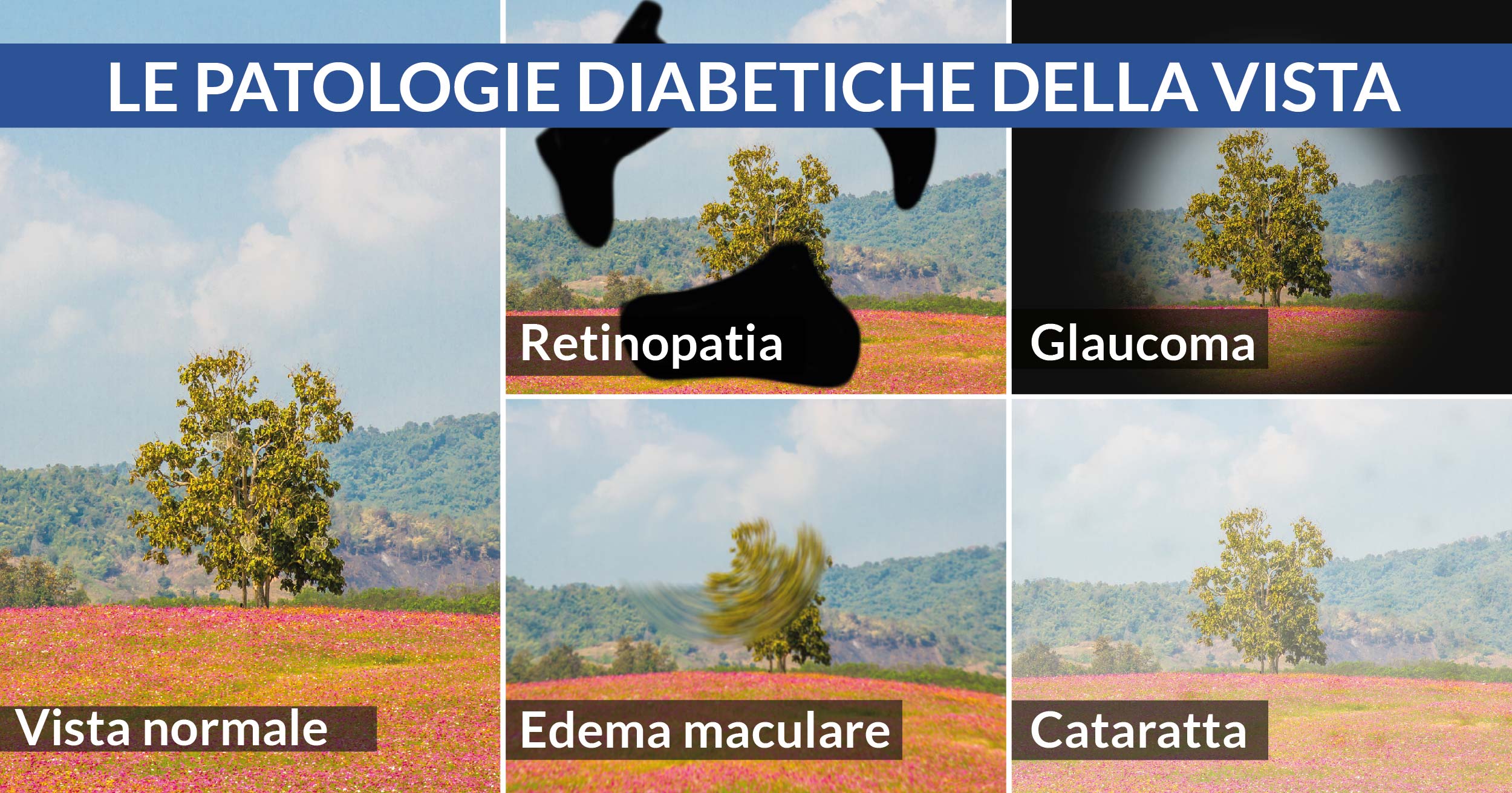 patologie diabetiche della vista cardiocenter napoli