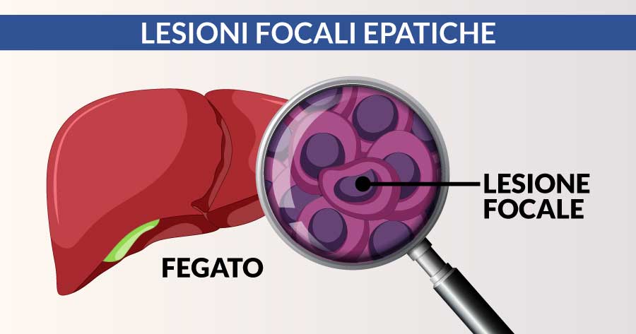 lesioni-focali-epatiche-cardiocenter-napoli