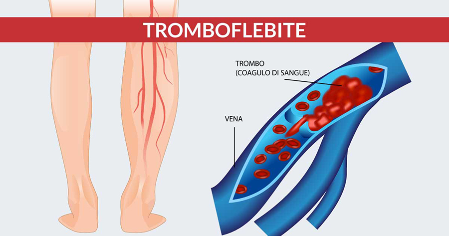 Tromboflebite: cause e sintomi