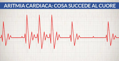 Aritmia cardiaca: cosa succede al cuore